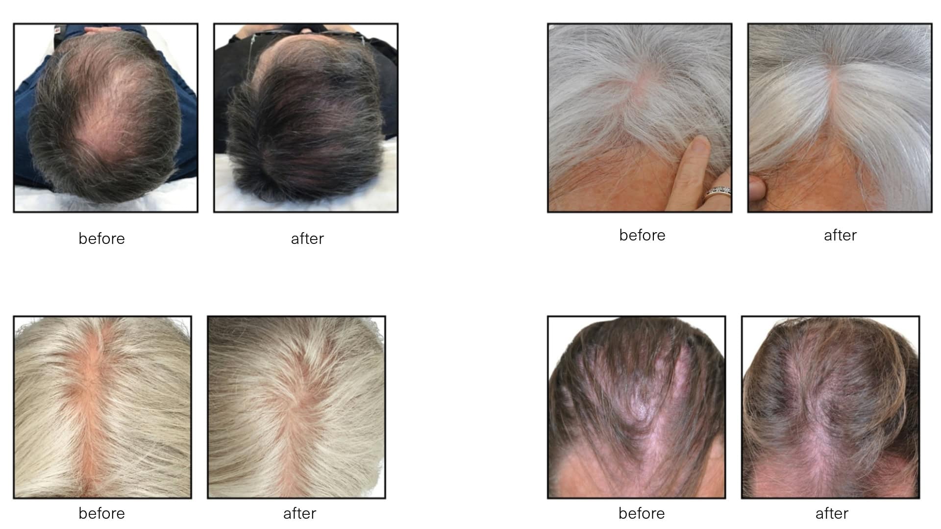 Hair loss treatment